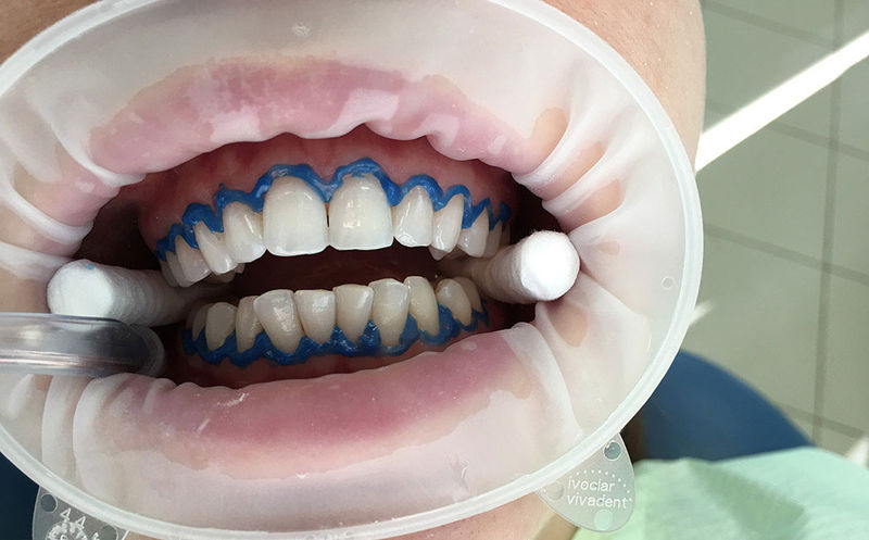 Своевременный уход за зубами