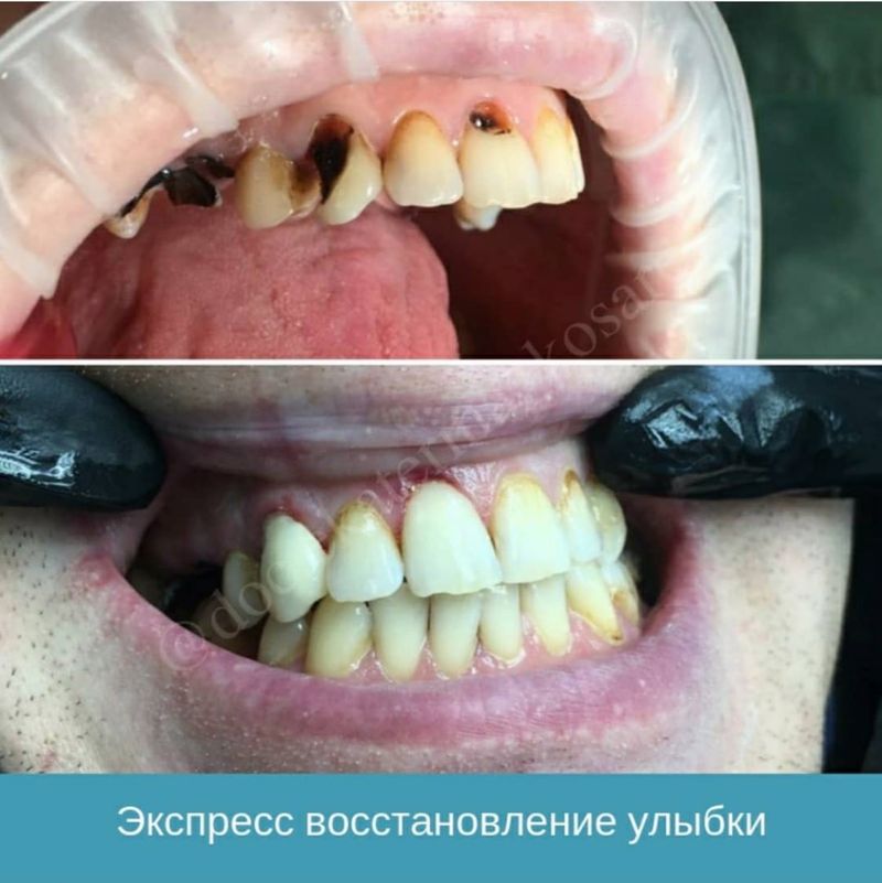 Экспресс-восстановление улыбки в Москве - клиника Екатерины Косаревой