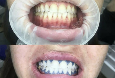 Рекомендации после отбеливания зубов в Москве - клиника Екатерины Косаревой