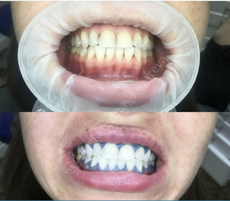 Рекомендации после отбеливания зубов в Москве - клиника Екатерины Косаревой