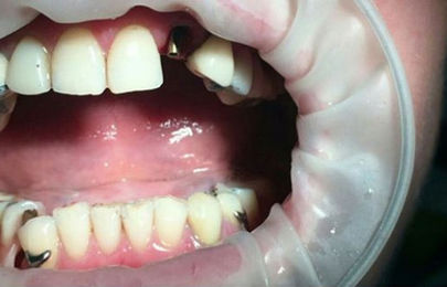 Имплант в область зуба 2.2 - фото ДО