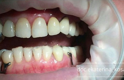 Имплант в область зуба 2.2 - фото ПОСЛЕ