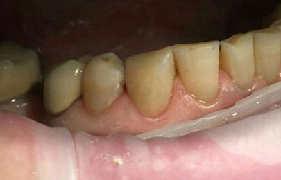 Реставрация зуба 4.3  - фото ПОСЛЕ