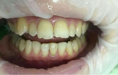 Миниинвазивная реставрация передних зубов - фото ДО
