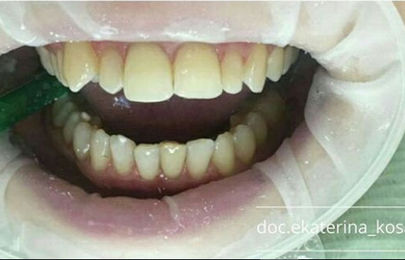 Миниинвазивная реставрация передних зубов - фото ПОСЛЕ