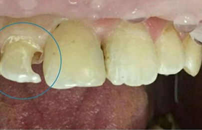 Реставрация зуба 1.2. - фото ДО