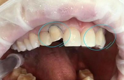 Виниры на передние зубы 1.2 и 2.2 - фото ДО