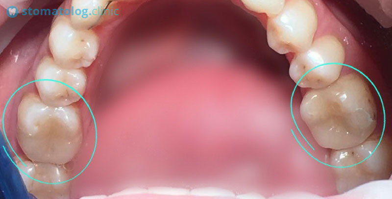 Керамические вкладки на модели и в полости рта